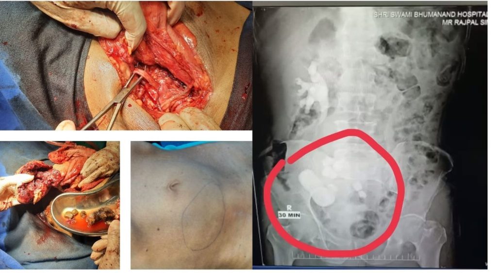 rare case where the patient having, non functional obstructed ectopic kidney operated (Nephrectomy)